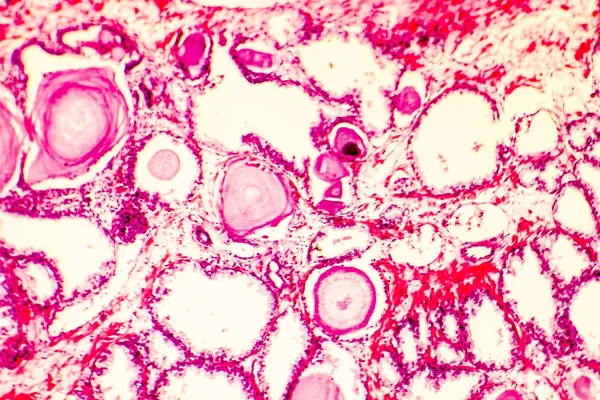 Prostat hiperplazisi photomicrograph
