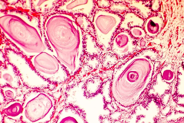 Fotomicrografía de la hiperplasia de próstata — Foto de Stock