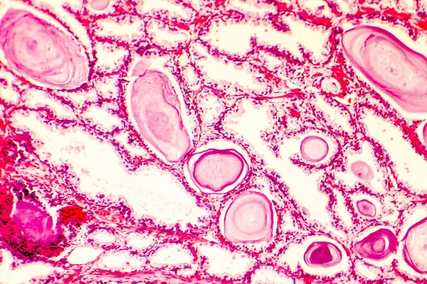 Prostat hiperplazisi photomicrograph