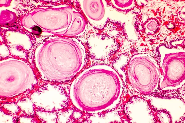 Prostat hiperplazisi photomicrograph