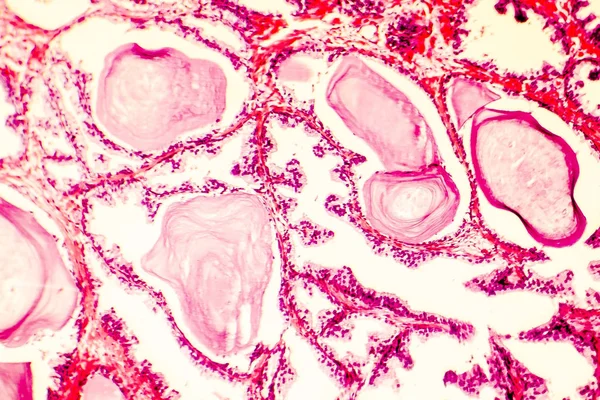 Photomicrograph av prostata hyperplasi — Stockfoto