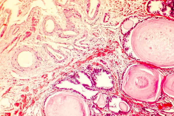 전립선 비 대 증의 photomicrograph — 스톡 사진