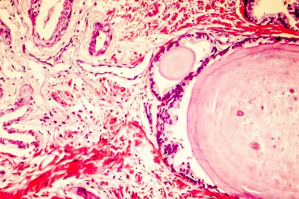 전립선 비 대 증의 photomicrograph — 스톡 사진