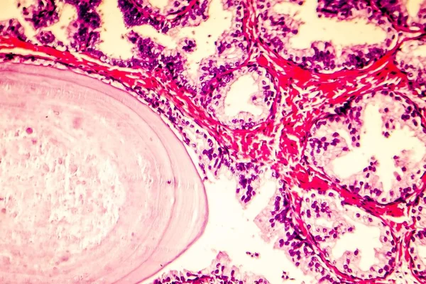 Prostat hiperplazisi photomicrograph