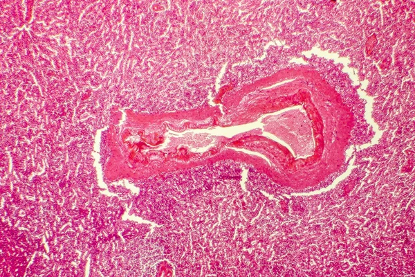 Splenik arter hiyalin dejenerasyonu