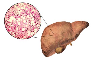 Fatty liver, liver steatosis clipart
