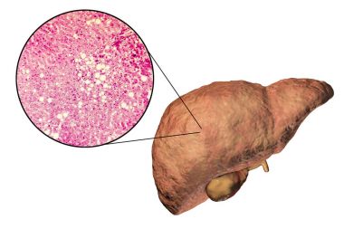 Fatty liver, liver steatosis clipart