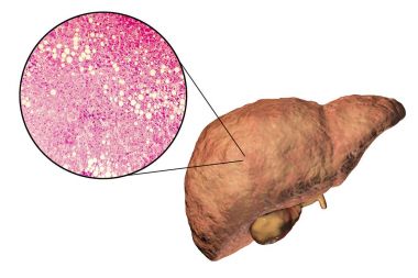 Fatty liver, liver steatosis clipart