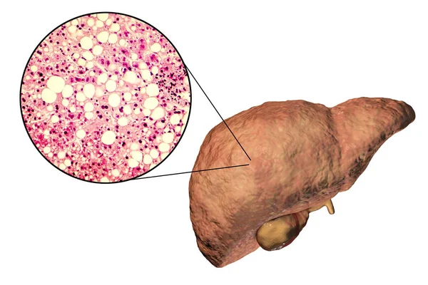 Fatty liver, liver steatosis — Stock Photo, Image