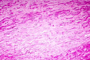 Kalp kapakçığı, hafif photomicrograph myxoid dejenerasyonu