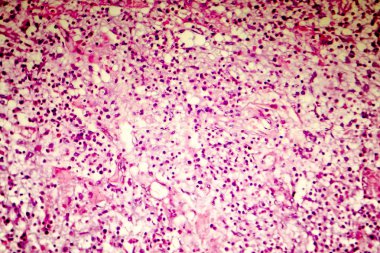 İnsan beyni, hafif photomicrograph liquefactive nekrozu