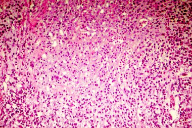 İnsan beyni, hafif photomicrograph liquefactive nekrozu