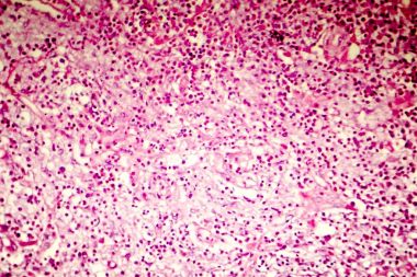 İnsan beyni, hafif photomicrograph liquefactive nekrozu