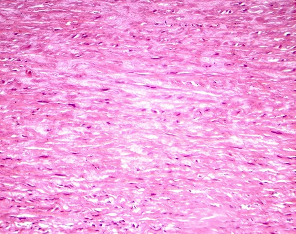 Myxoid degeneration of heart valve, light photomicrograph