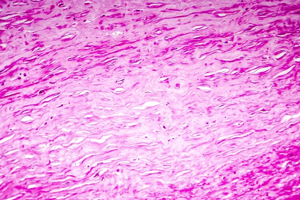 Myxoid zwyrodnienia zastawki serca, światła photomicrograph — Zdjęcie stockowe