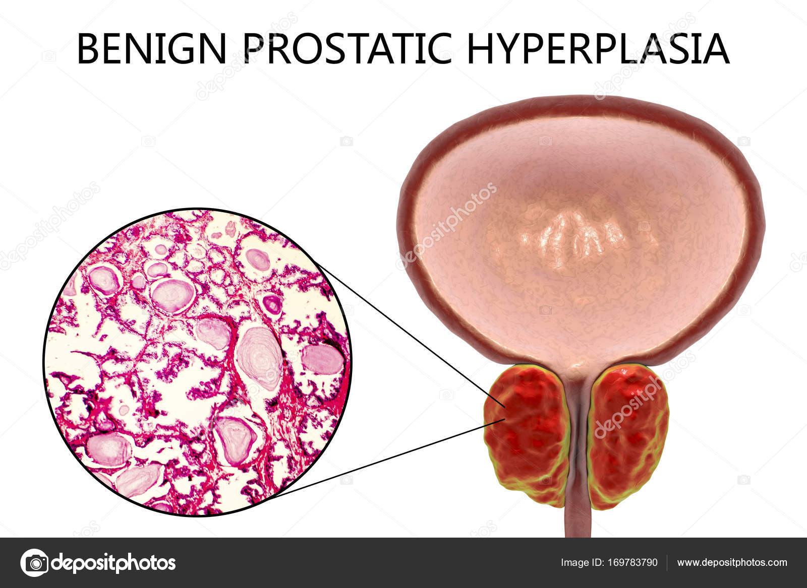 jóindulatú hyperplasia prostat