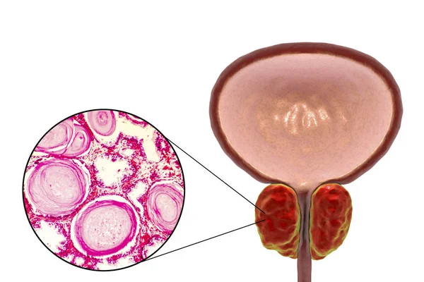 Hiperplasia prostática benigna — Foto de Stock