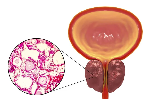 Benign prostatic hyperplasia — Stock Photo, Image