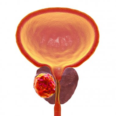 Prostat kanseri, illüstrasyon