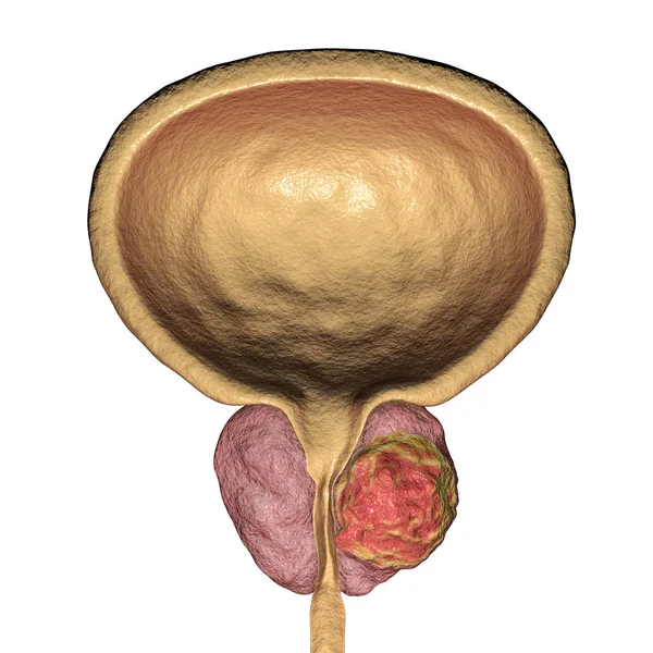 Ilustracja raka prostaty — Zdjęcie stockowe