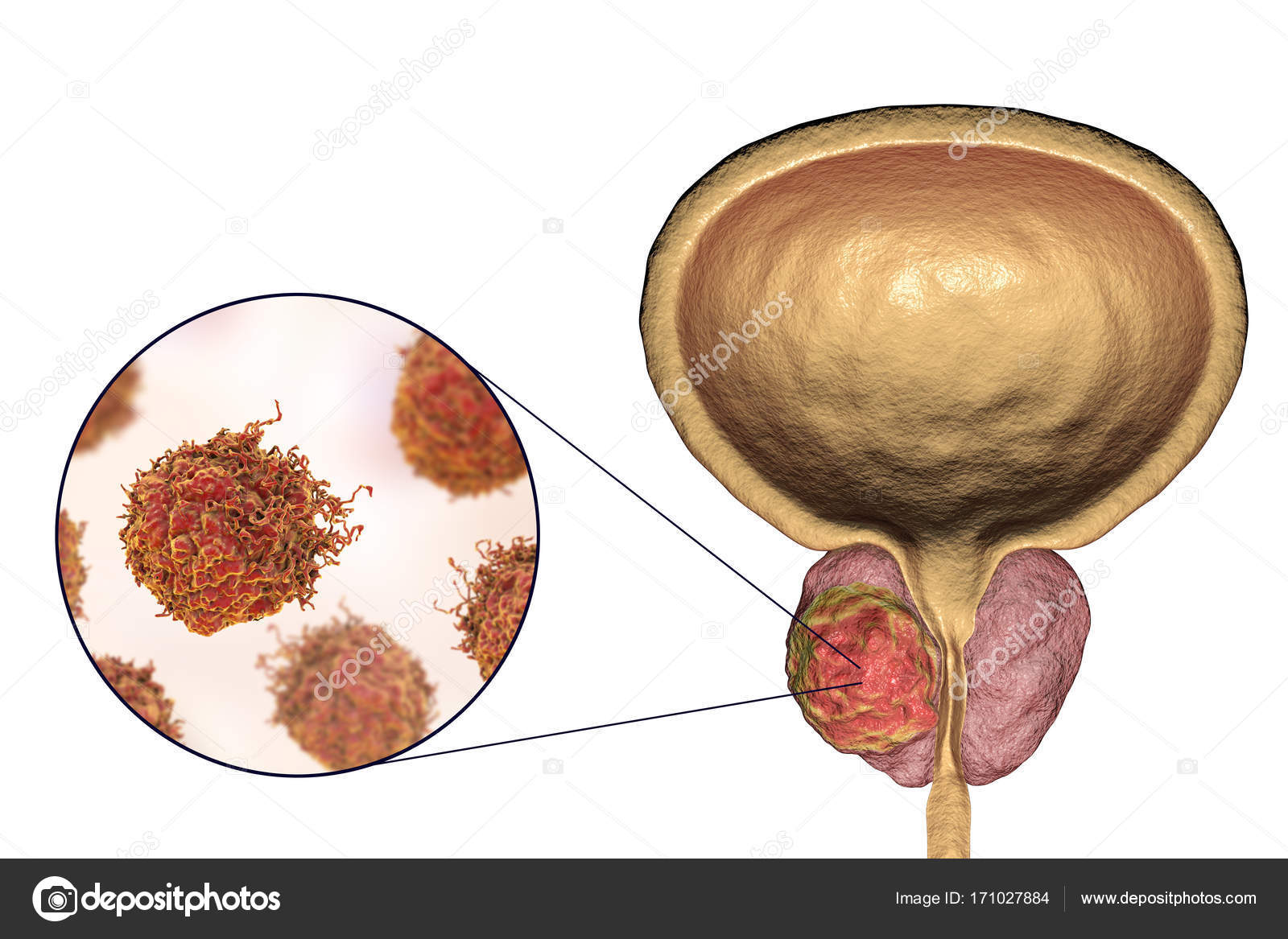 Последствия рака предстательной железы. Cancer предстательной железы. Онкология простаты стадии. Онкология простаты 3 степени продолжительность жизни. Злокачественное новообразование предстательной железы.
