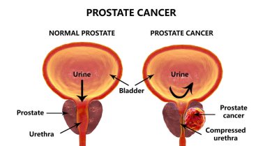 Prostat kanseri, illüstrasyon
