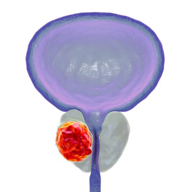 Prostat kanseri, illüstrasyon