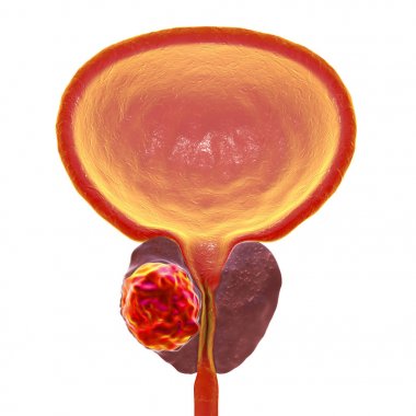 Prostat kanseri, illüstrasyon