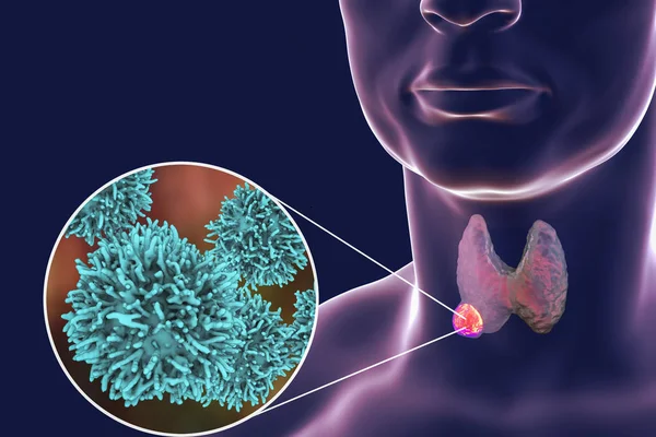 Thyroid cancer illustration — Stock Photo, Image