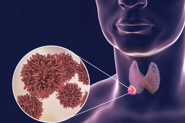 Иллюстрация рака щитовидной железы — стоковое фото