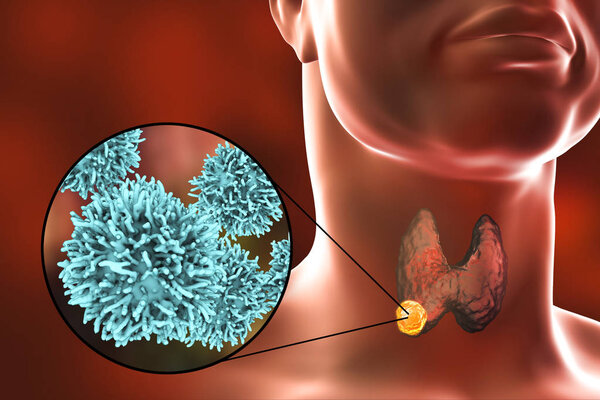 Thyroid cancer illustration