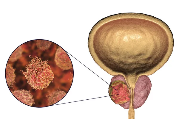 Рак передміхурової залози, ілюстрація — стокове фото