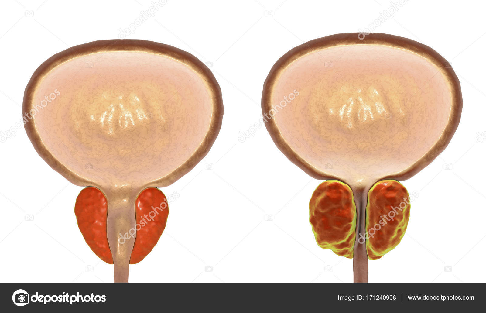 hipertrofia prostática benigna bph