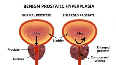 İyi huylu prostat hiperplazisi