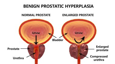 Benign prostatic hyperplasia clipart
