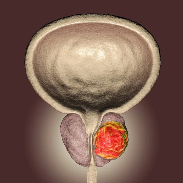 Prostate cancer illustration