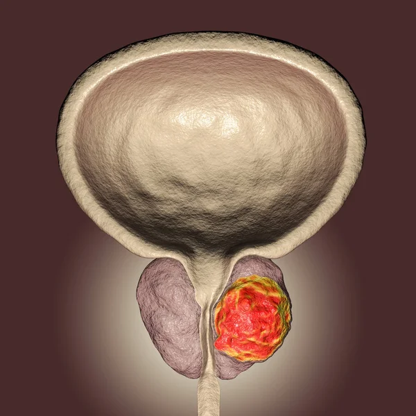 前列腺癌插图 — 图库照片