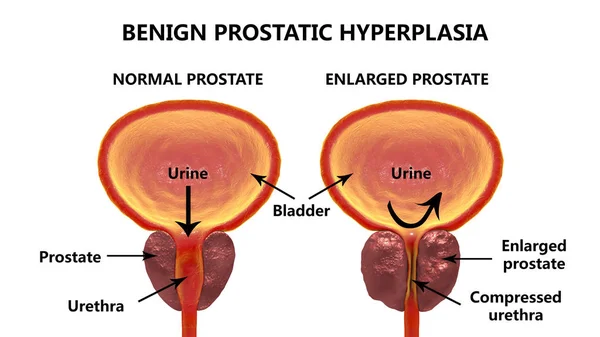 Godartad prostataförstoring — Stockfoto