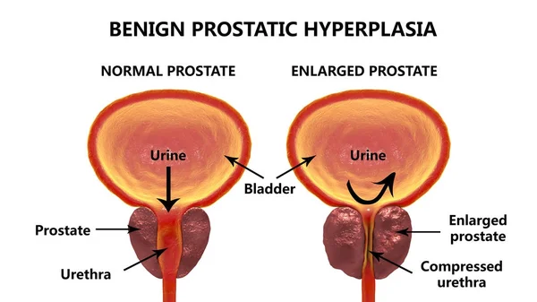 bph prostata)
