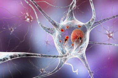 Neurons in Parkinson's disease clipart
