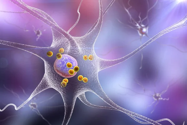 Neuronů v Parkinsonova nemoc — Stock fotografie