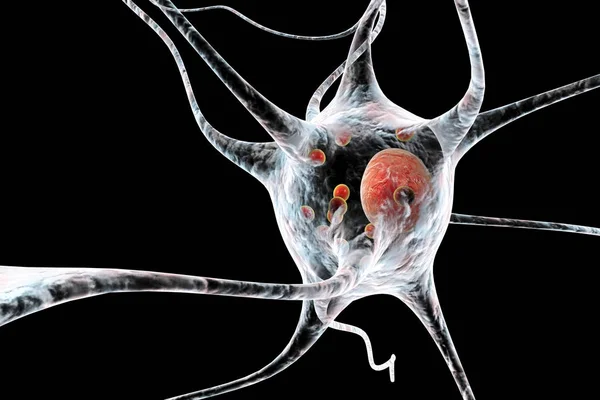 Neuronen die in ziekte Parkinson's — Stockfoto