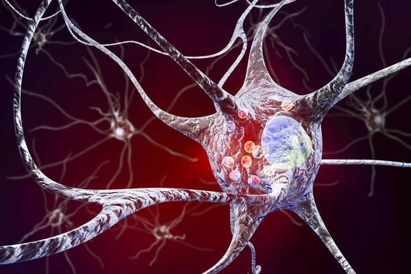 Neuronů v Parkinsonova nemoc — Stock fotografie