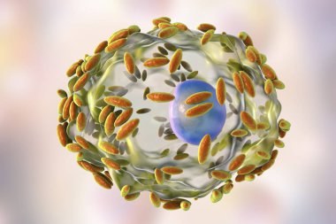 Bakteriyel vaginosis mikroskobik tanısında. Epitel hücre, sözde ipucu hücre Gardnerella Vajinalis bakteri ile kaplıdır