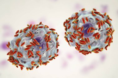 Bakteriyel vaginosis mikroskobik tanısında. Epitel hücre, sözde ipucu hücre Gardnerella Vajinalis bakteri ile kaplıdır