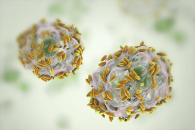 Bakteriyel vaginosis mikroskobik tanısında. Epitel hücre, sözde ipucu hücre Gardnerella Vajinalis bakteri ile kaplıdır