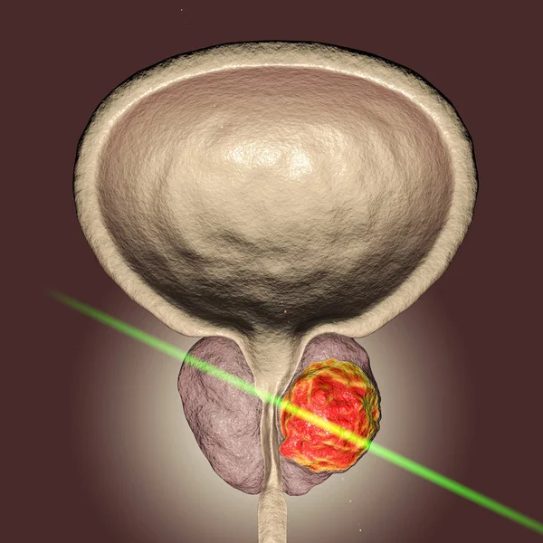 前列腺癌治疗的概念性图像 — 图库照片