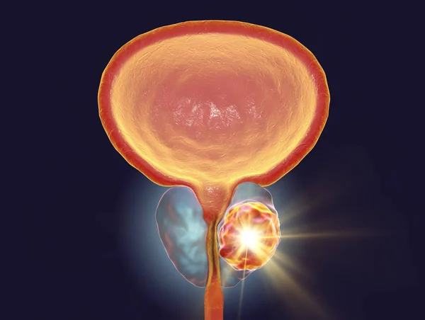 Conceptual image for prostate cancer treatment