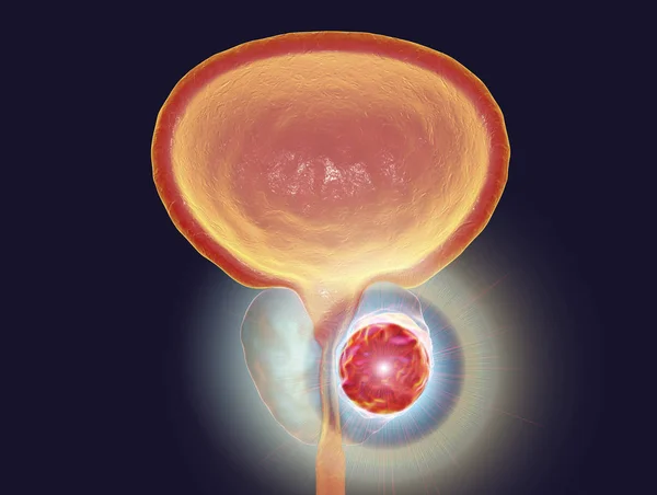Imagen conceptual para el tratamiento del cáncer de próstata — Foto de Stock
