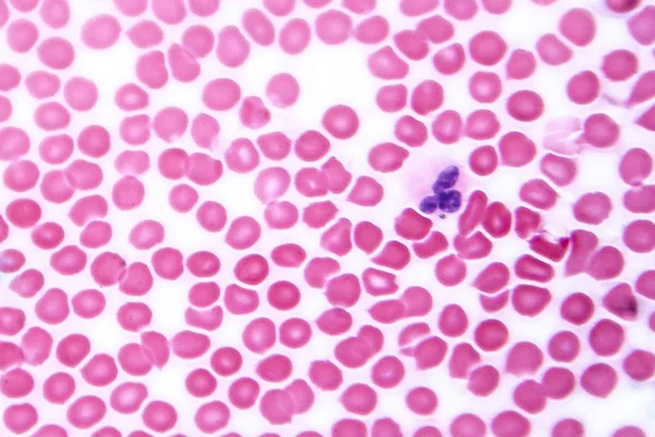 Mikroskop altında insan Kan yayması — Stok fotoğraf